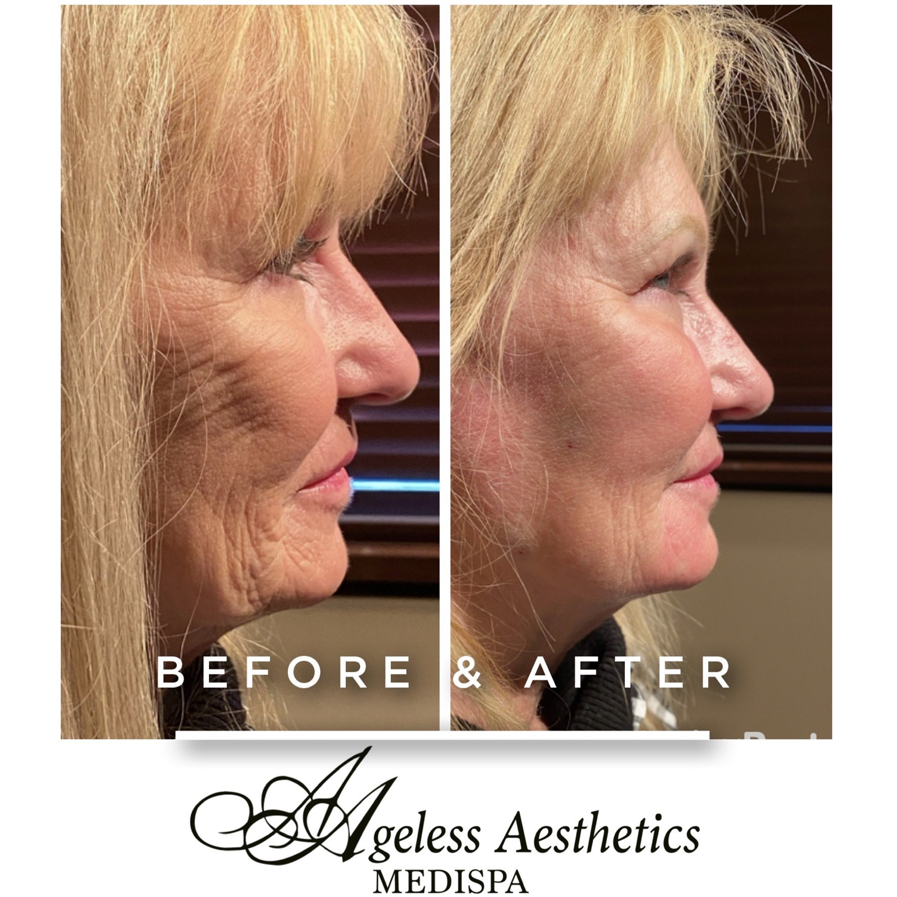 Sculptra Ashland KY  - Before & After Treatment