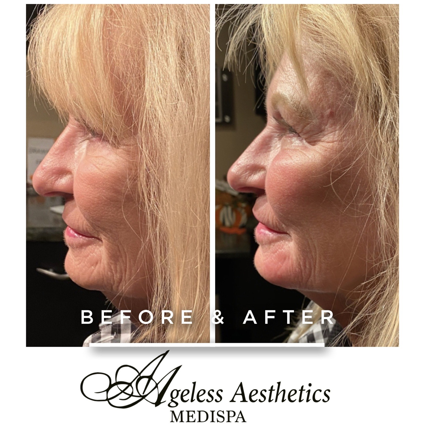 Sculptra Ashland KY  - Before & After Treatment