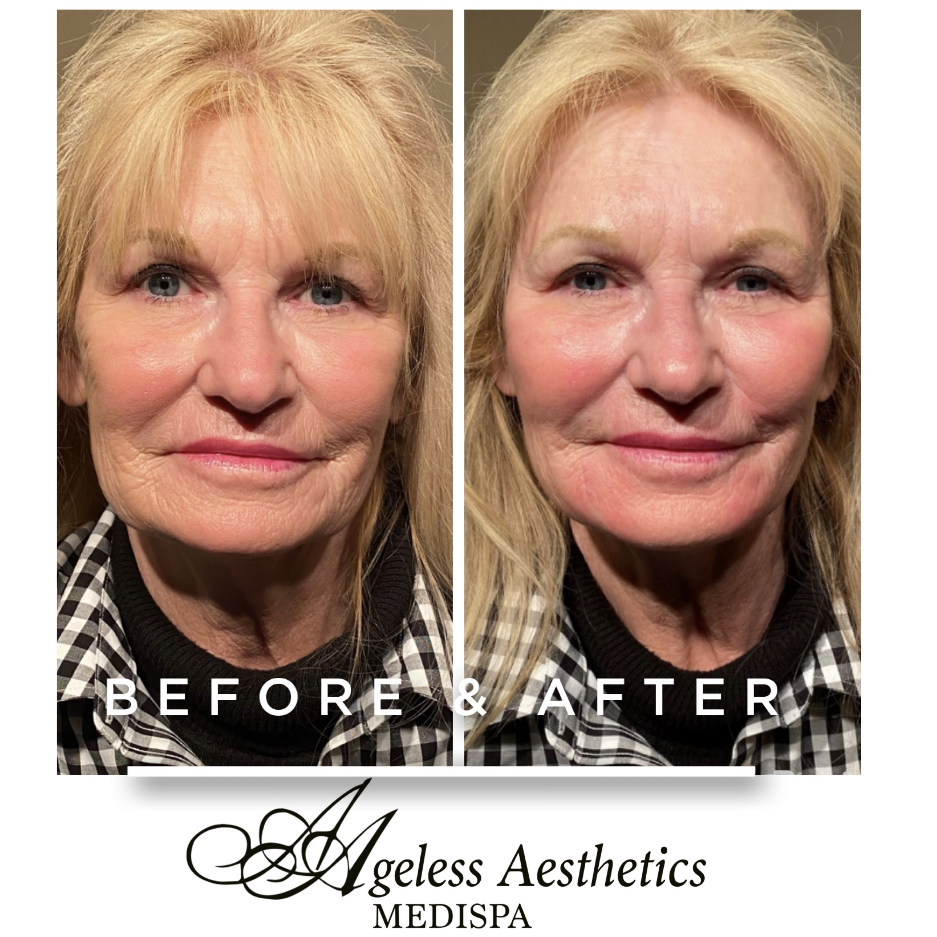 Sculptra Ashland KY  - Before & After Treatment