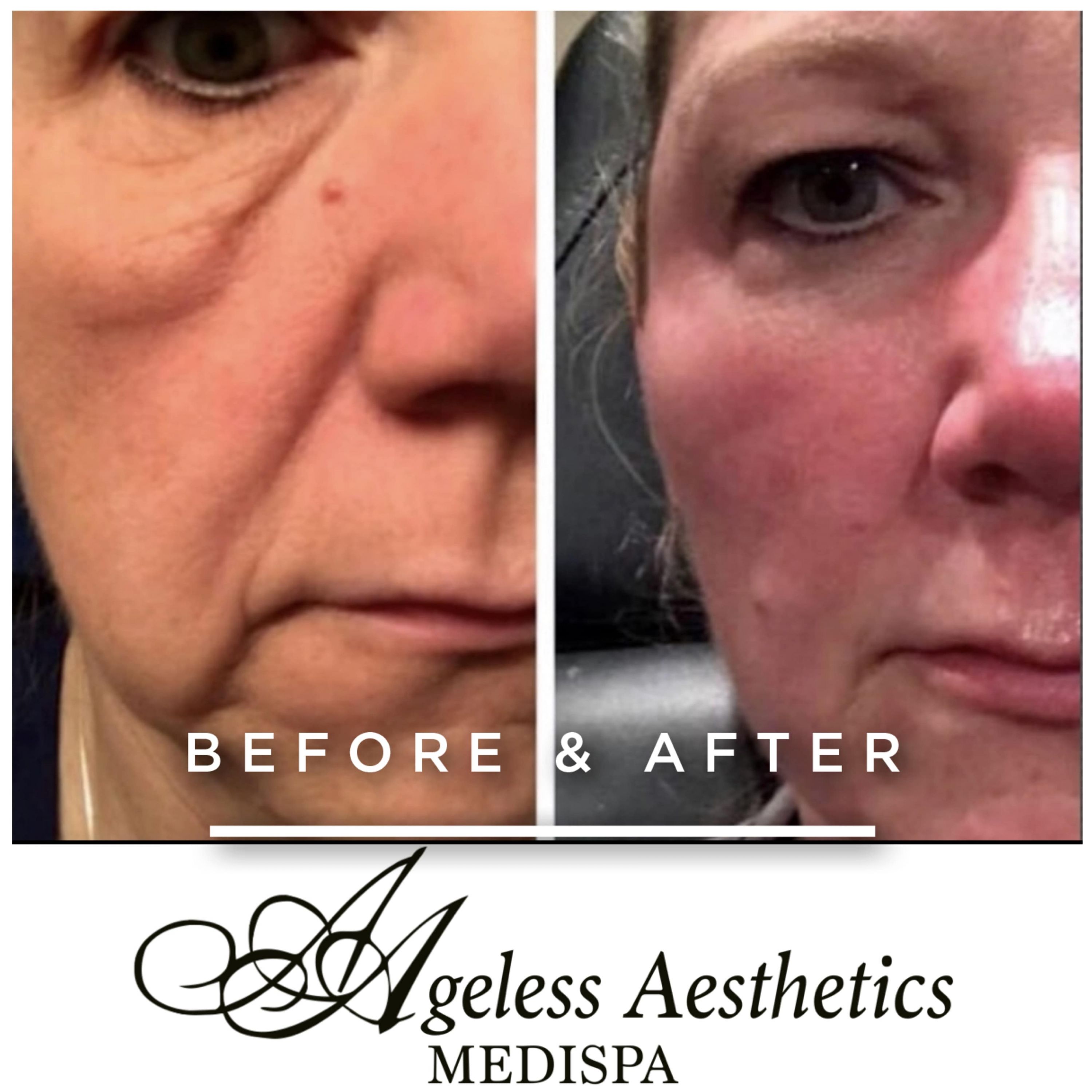 Sculptra Ashland KY  - Before & After Treatment