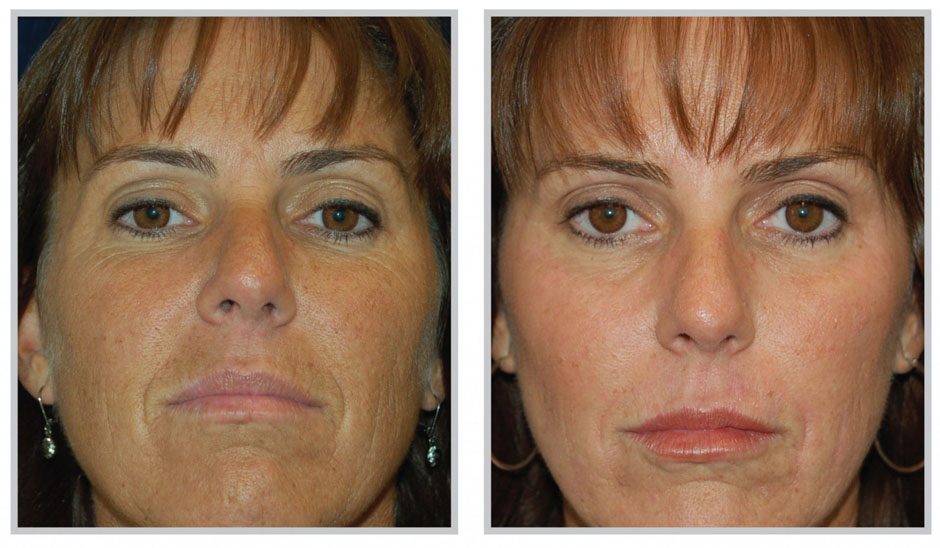 Snowball Facial Ashland KY  - Before & After Treatment