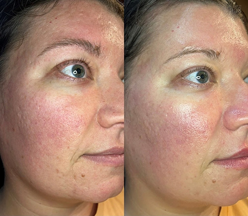 24K Facial Ashland KY - Before & After Treatment