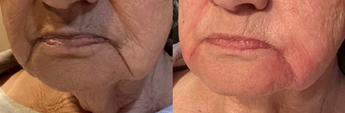 Dermal Filler Ashland KY - Before & After Lower Face and Lip Treatment