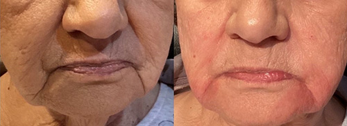 Dermal Filler Ashland KY - Before & After Lower Face and Lip Treatment