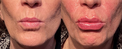 Dermal Filler Ashland KY - Before & After Lower Face and Lip Treatment