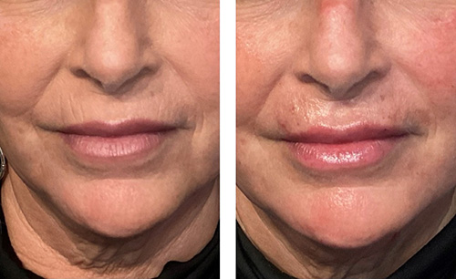 Dermal Filler Ashland KY - Before & After Lower Face and Lip Treatment