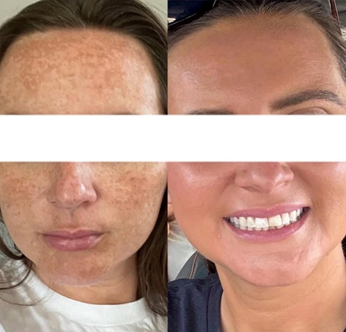 Microneedling Ashland KY - Before & After Treatment