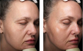 Ultherapy Ashland KY  - Before & After Treatment