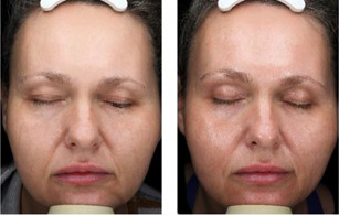 Ultherapy Ashland KY  - Before & After Treatment