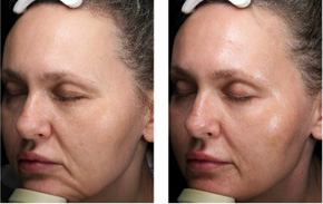 Ultherapy Ashland KY  - Before & After Treatment