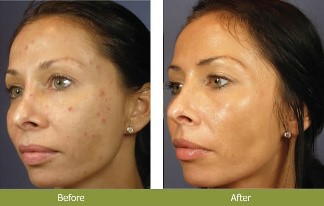 Chemabrasion Ashland KY - Before & After Treatment