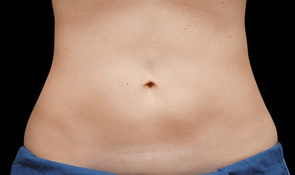 CoolSculpting Ashland KY - After Treatment