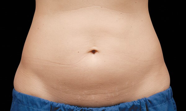 CoolSculpting Ashland KY - Before Treatment