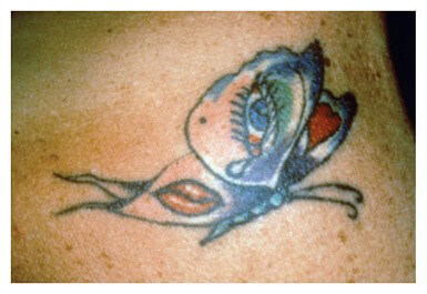 Laser Tatoo Removal Ashland KY - Before Treatment