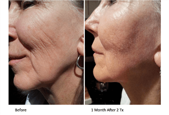 PRP Microneedling Facial Ashland KY - Before & After Treatment