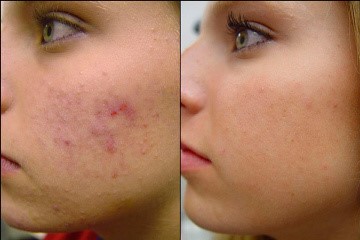 Acne Facial Ashland KY - Before & After