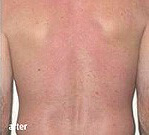 Laser Hair Removal Ashland KY - After Treatment