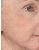 Fractional Laser Skin Resurfacing  Ashland KY - After Treatment