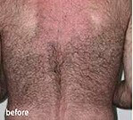 Laser Hair Removal Ashland KY - Before Treatment