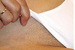 Laser Hair Removal Ashland KY - Before Treatment