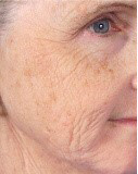 Fractional Laser Skin Resurfacing Ashland KY - Before Treatment