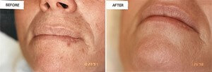 Microdermabrasion Ashland KY - Before & After Treatment