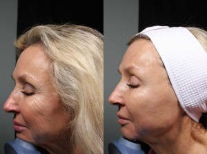 PRP Microneedling Facial Ashland KY - Before & After Treatment