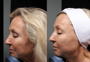 Microneedling Ashland KY - Before & After Treatment