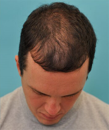 PRP Hair Restoration Ashland KY - After Treatment