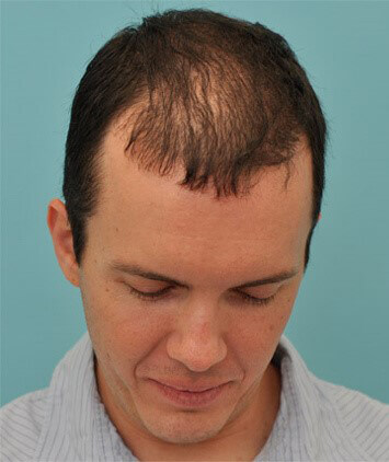 PRP Hair Restoration Ashland KY - Before Treatment