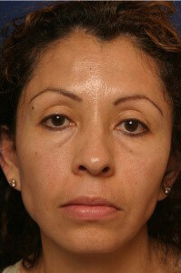 PRP Facelift Ashland KY - Before Treatment