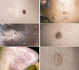 Skin Tag Removal Ashland KY