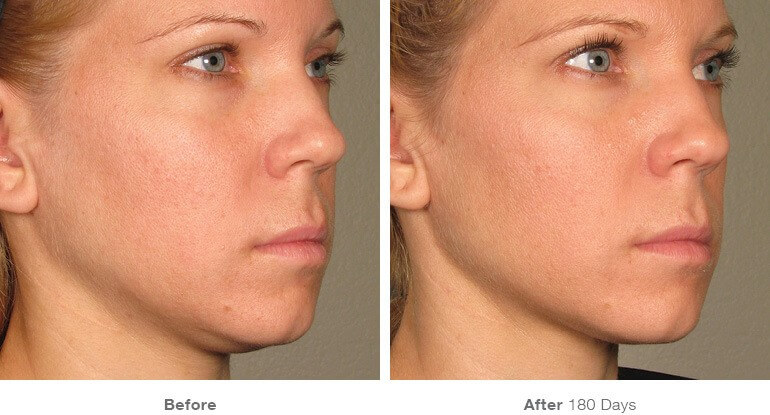 Ultherapy Ashland KY  - Before & After Treatment