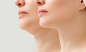 Non-surgical Facelifts Ashland KY